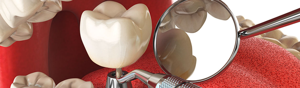 Dentalimplantatbehandlung Zahnzentrum Neukölln Althoff & Kollegen